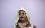 Xót xa khi chứng kiến hình ảnh trẻ đói ăn suy dinh dưỡng ở Yemen