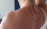 7 tác hại đáng sợ của tia UV đối với cơ thể