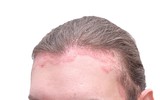 [ẢNH] Những tác hại đáng sợ do nhuộm tóc thường xuyên