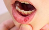 [ẢNH] Những giải pháp tự nhiên giúp điều trị nhiệt miệng cực hiệu quả
