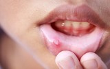 [ẢNH] Những giải pháp tự nhiên giúp điều trị nhiệt miệng cực hiệu quả