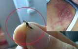 [Ảnh] Nhận diện những dấu hiệu tổn thương do kiến ba khoang và cách xử lý 
