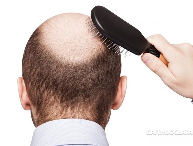 Nguyên nhân tóc rụng nhiều ở nữ và 7 cách khắc phục tại nhà – Natonic  Vietnam