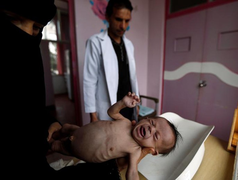 Xót xa khi chứng kiến hình ảnh trẻ đói ăn suy dinh dưỡng ở Yemen
