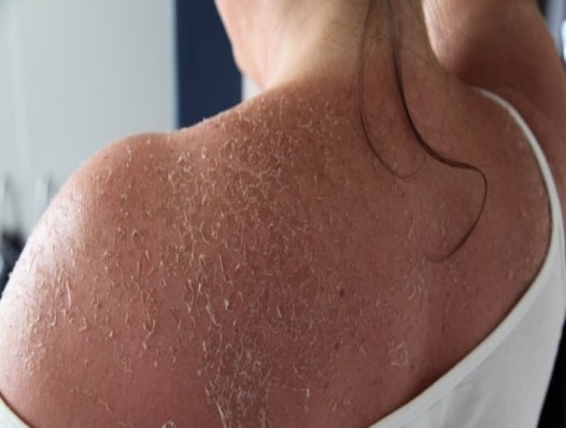 7 tác hại đáng sợ của tia UV đối với cơ thể