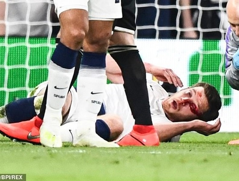 [ẢNH] Rợn người hình ảnh sao Tottenham nằm sân với khuôn mặt đầm đìa máu