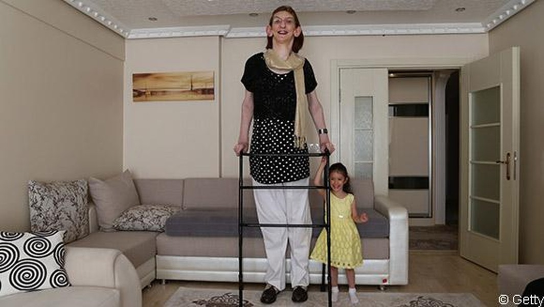 Người phụ nữ cao nhất thế giới do mắc bệnh hiếm