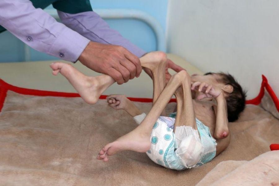 [ẢNH] Xót xa cậu bé Yemen 7 tuổi chỉ nặng có 7kg vì nạn đói